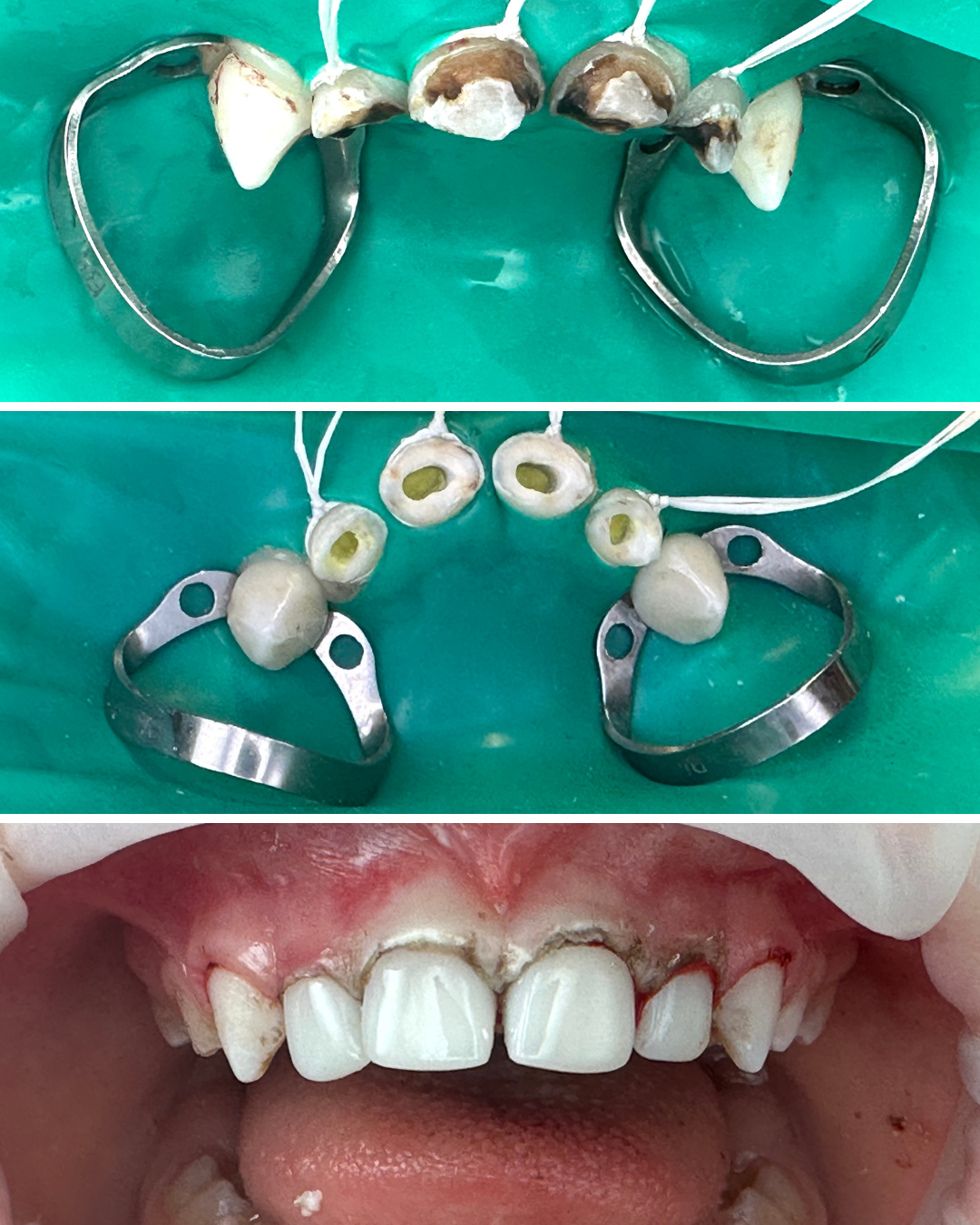 Etapă de tratament sub digă