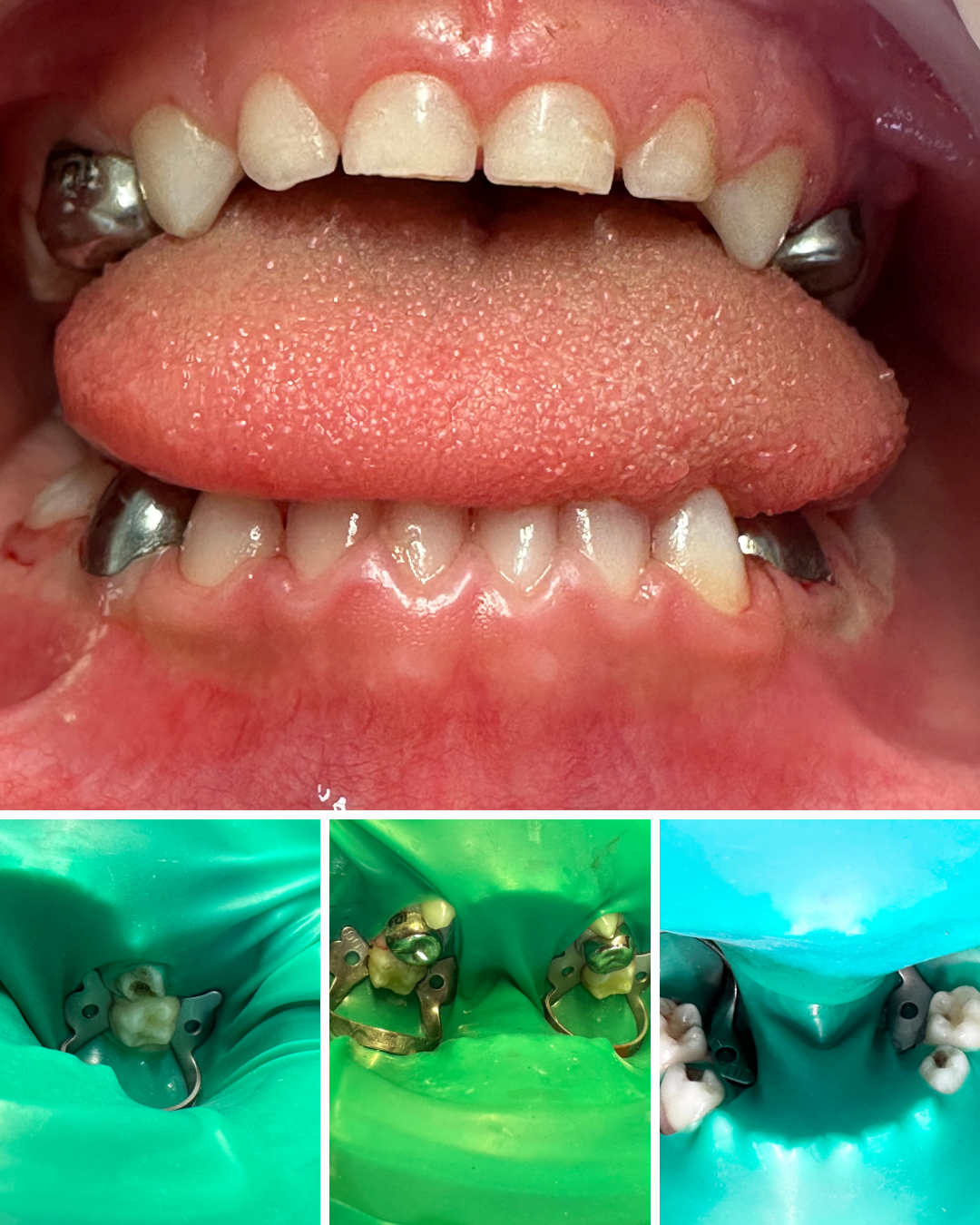 Restaurare dinți de lapte în curs